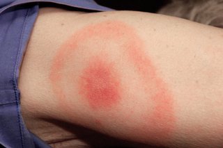 Lyme Disease and PEMF Therapy.