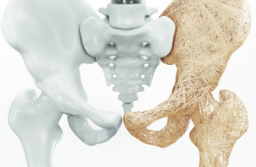 Osteoporosis and PEMF therapy study.